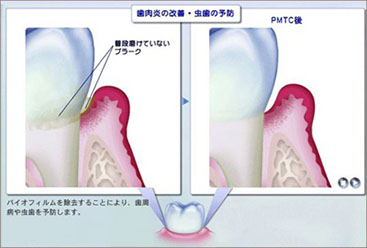 歯肉炎の改善・虫歯の予防