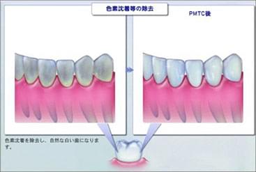 色素沈着等の除去