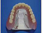 コバルト・クロム床義歯